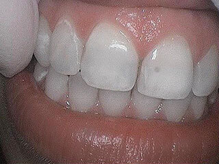 Patient 1 - before veneers Patient 1 - before veneers