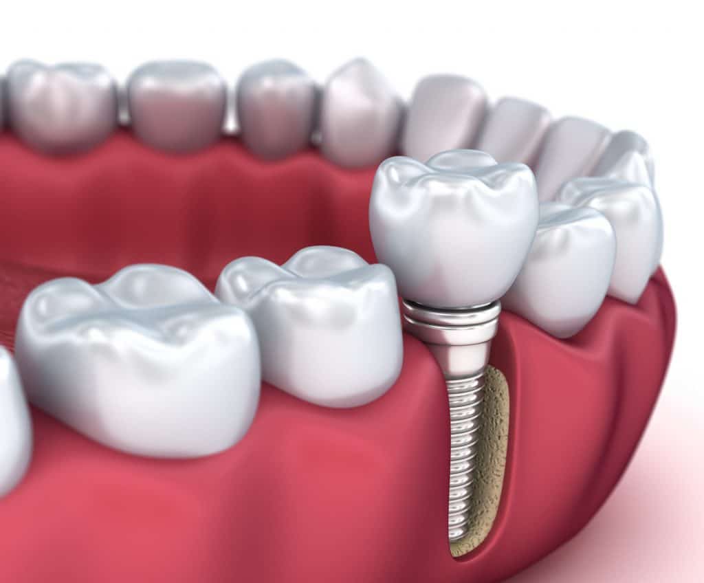 Beginner’s Guide to Dental Implants