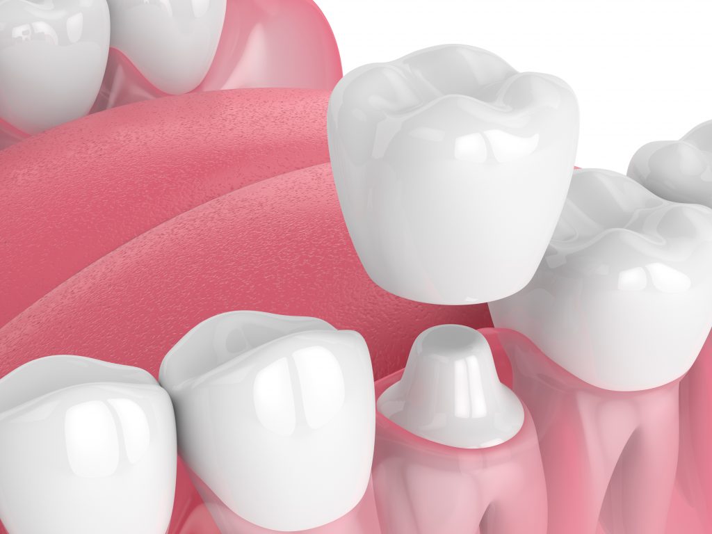 What Type of Dental Crown Should I Choose? 5 Main Types