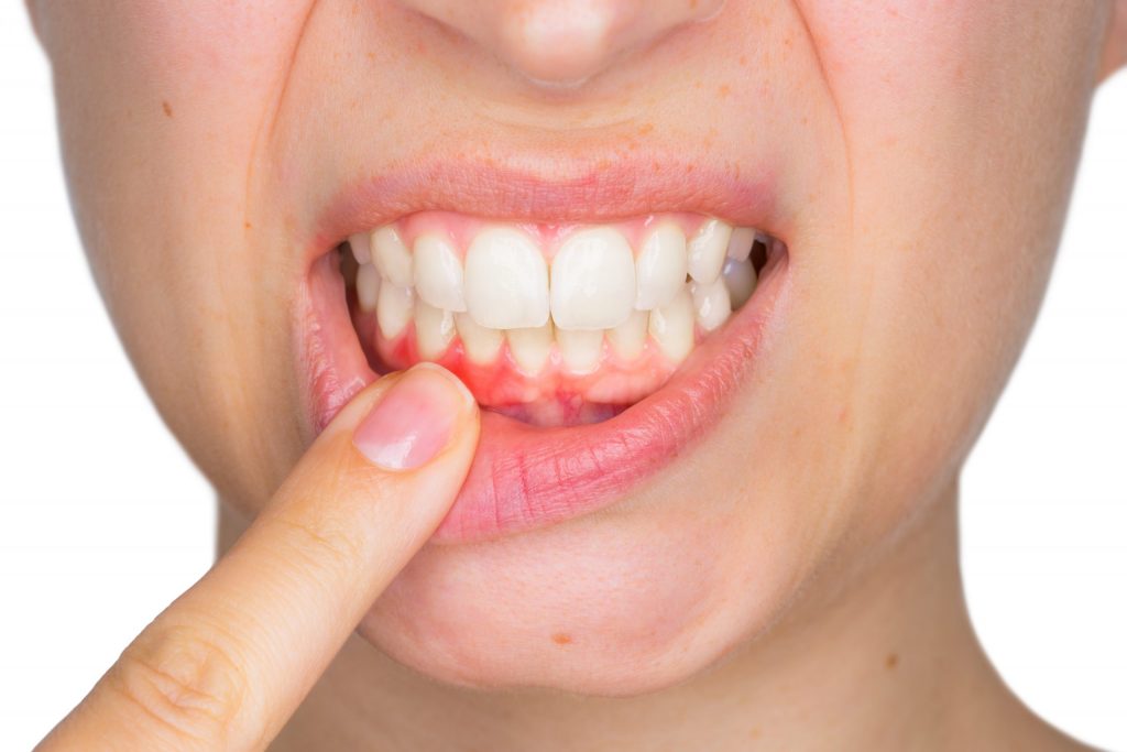 6 Ways to Find Out Gum Disease