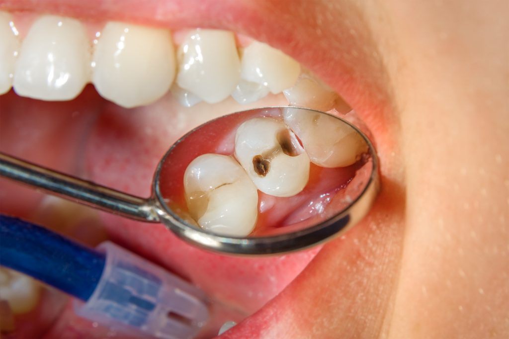 9 Creative Ways to Prevent Cavities