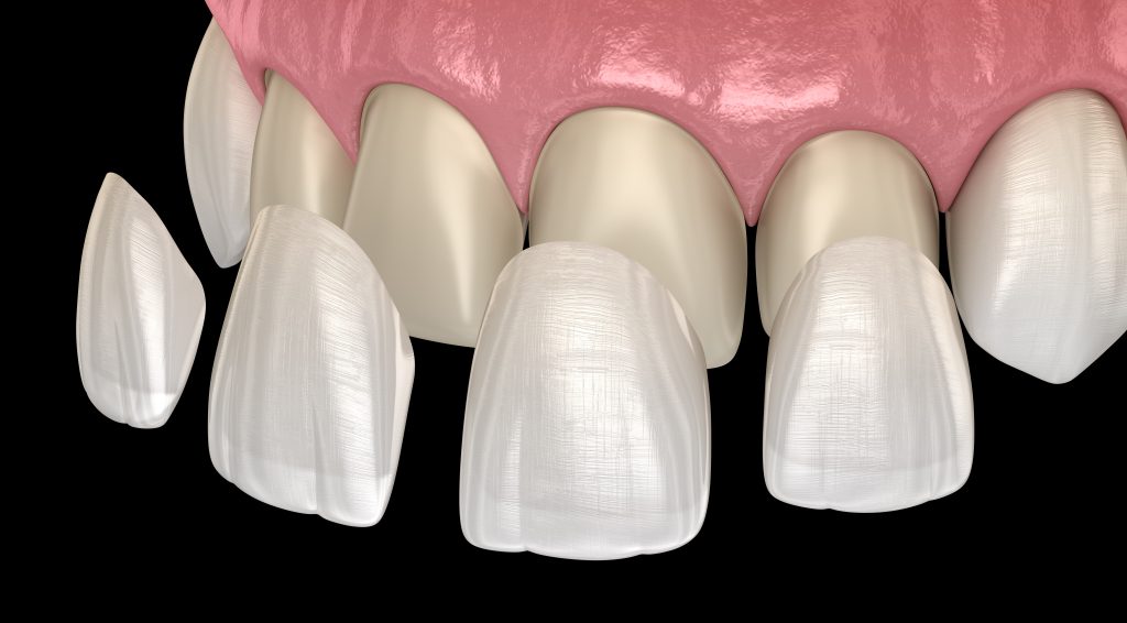 dental veneers in Mission Valley