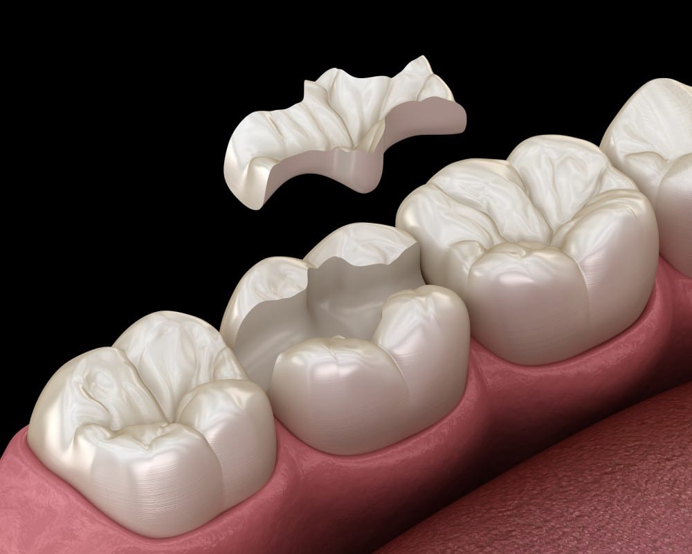 What are Dental Inlays and Onlays