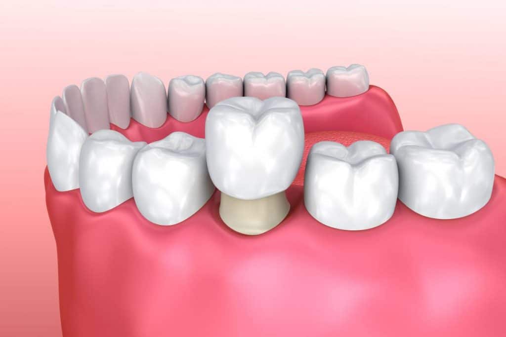 Are dental crowns right for you?