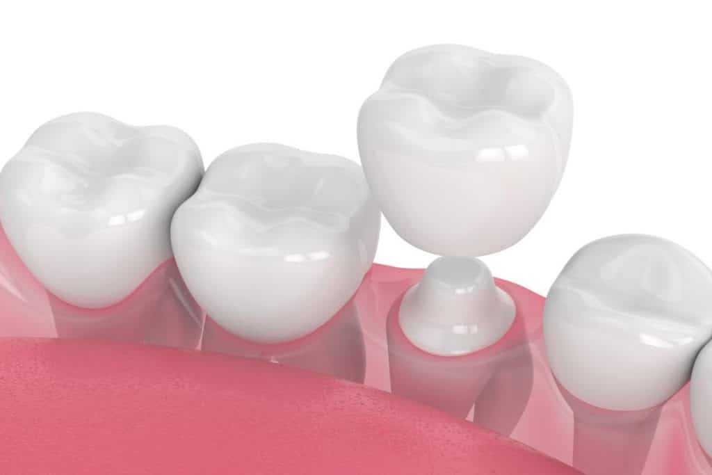 Dental Crown After Root Canal Treatment