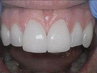 After Dental Crowns