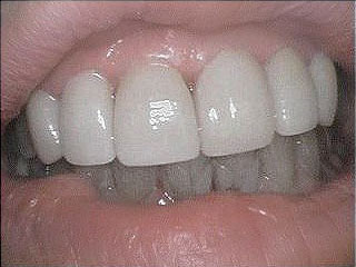 After Dental Veneers Treatment