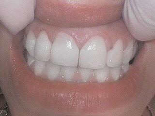 After Dental Veneers