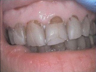 Before Dental Veneers Treatment