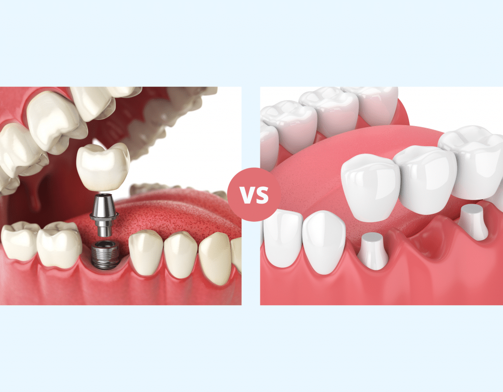 Dental implants vs Dental bridges