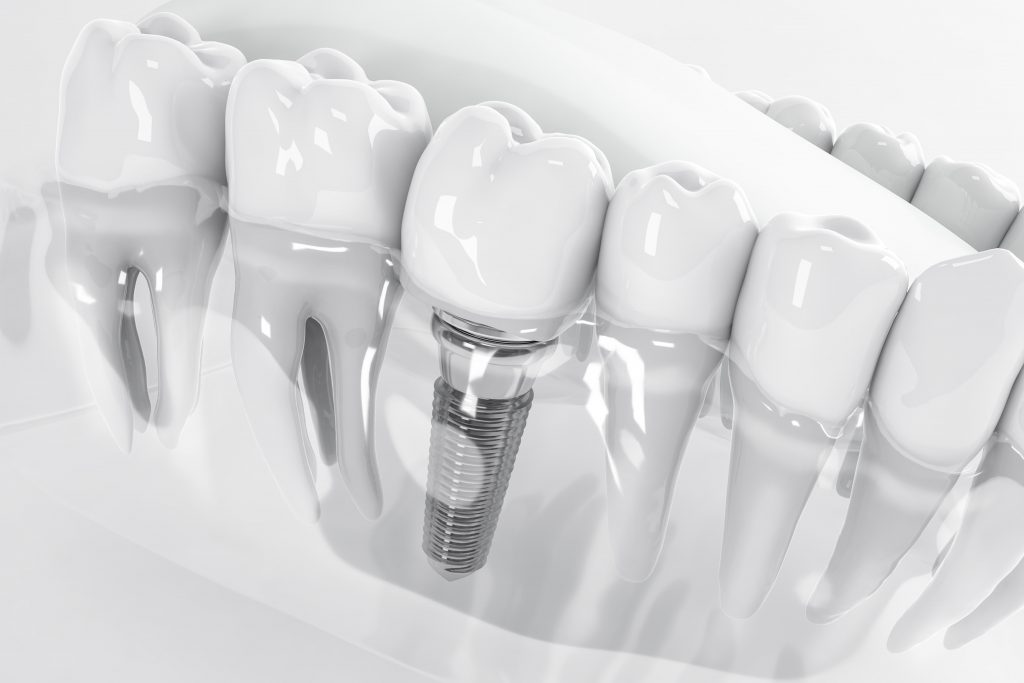 what are the requirements for dental implants